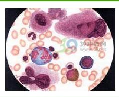 什么叫免疫性血小板减少 20091029141402-1629031065.jpg