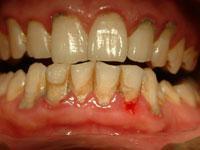 慢性牙周炎-+搜狗百科