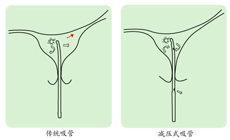 微管人流+-+搜搜百科