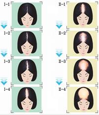 而一般<em>女性</em>的<em>斑秃</em>以及少女拔毛癖等则不在此列