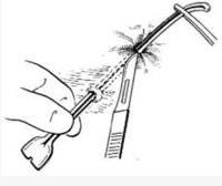 简单肛瘘切除术