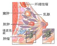 乳房肿块是最常见的乳房疾患