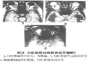 眼眶肿瘤中60例,仅占4.6%