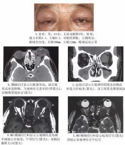 局限在眼眶的某一些组织导致眼外肌炎周围神经炎周围巩膜炎和泪腺炎