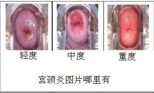 白带增多,呈粘稠的粘液或脓性粘液