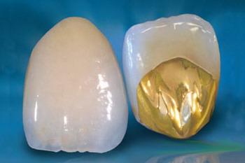 镍铬合金烤瓷牙