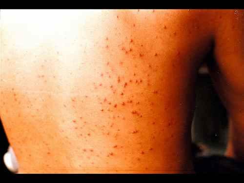 毛囊炎症状图片