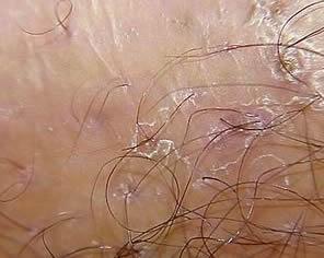 肿胀及疼痛等<em>女性毛囊炎</em>症状