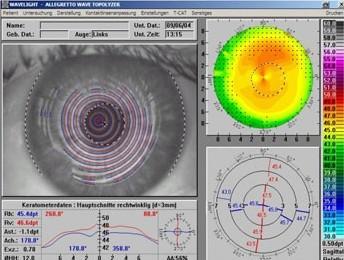 角膜地形图