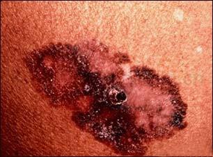 病灶部位恶性黑色素瘤的发生部位与预后有关