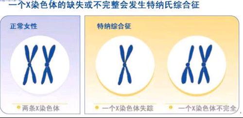 女性先天性性腺发育不全或