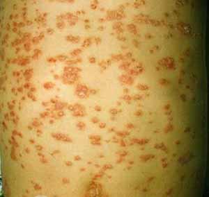 点滴状多半有心气皮疹