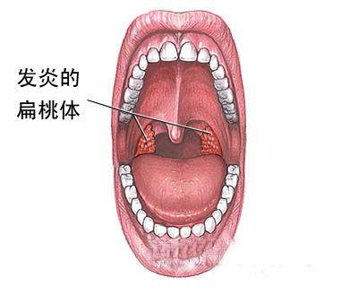 tonsillitis)是腭扁桃体的一种非特异性急性炎症,常伴有一定程度的咽