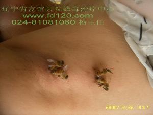 蜂疗-+搜搜百科