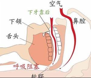 打鼾症