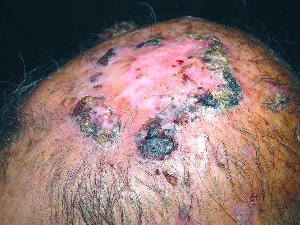 面部基底细胞癌+-+搜搜百科