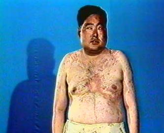 库欣综合征-+搜搜百科