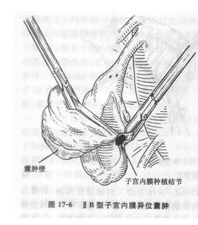 子宫内膜异位囊肿