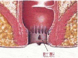 年轻女性痔_该词条缺少 基本信息栏 、 词条 ...