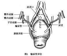 阴道脱垂