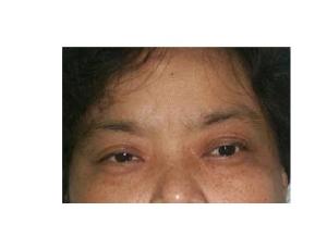 眼睑皮肤病+-+搜搜百科