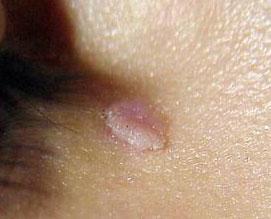 丝状疣是瘊子疾病当中的一种,是由人类乳头瘤