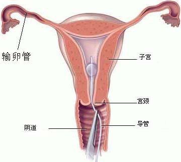 输卵管通畅检验经常采用四种方法:一