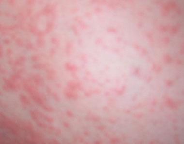 过敏性鼻炎,荨麻疹