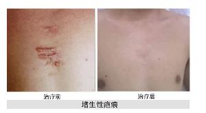 此时增生性疤痕组织