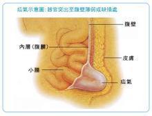 成人脐疝