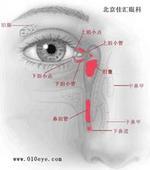 方法 采用鼻内窥镜电视显示下鼻泪管,泪道逆行插管治疗慢性泪囊炎