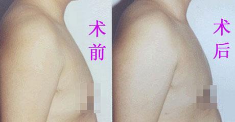 男性乳腺增生+-+搜搜百科