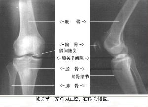 膝盖滑膜炎+-+搜搜百科