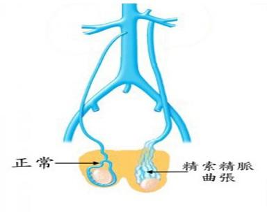 研究表明精索静脉曲张会引起进行性的睾丸功能