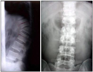 胸腰椎骨折后方骨韧带复合体损伤的探究