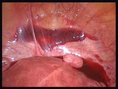 落而出现类似<em>月经</em>样阴道