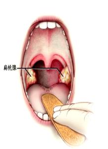 急慢性扁桃体炎