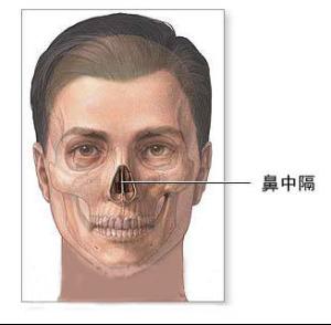 易发生鼻窦炎(特别是偏曲编辑2定义鼻中隔溃疡和穿孔,可继鼻部手术