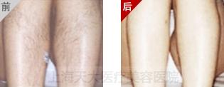 杰丽丝脱毛前后对比图