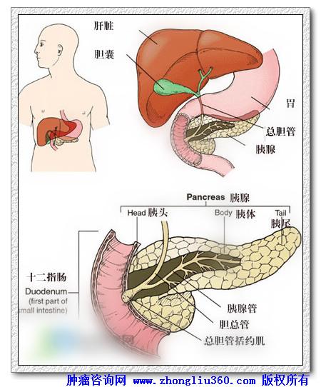 胰胆管扩张的ct表现对胰腺癌与慢性胰腺炎的诊断意义