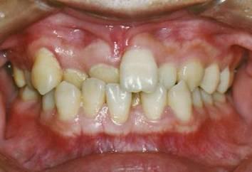 牙齿不齐+-+搜搜百科