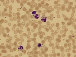 血小板减少症+-+搜搜百科