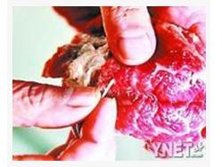 猪肉绦虫_人感染猪肉绦虫病是因为吃了（　　）A．猪肉绦虫的节片B．未充分煮熟的猪肉C．猪肉绦虫的成虫D．猪肉绦虫的幼虫