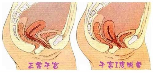 阴道前壁脱垂主要由于耻骨宫颈筋膜及膀胱宫颈