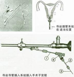 美国最新一代cook导丝术--有效治疗输卵管不通; 美国cook导丝介入术