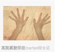 本病应用大量维生素b6治疗可获得较好疗效