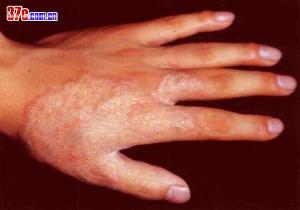 手癣(tinea manuum)是指发生在手掌和指间的皮肤癣菌感染.