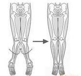 应有意识地纠正外八字脚的习惯;而内八字脚
