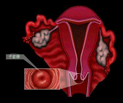 3度宫颈糜烂
