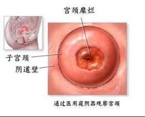 宫颈糜烂2度+-+搜搜百科